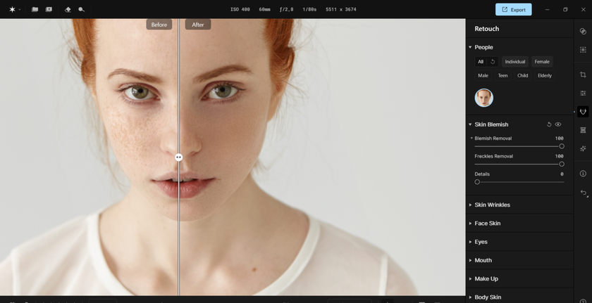 Skin Blemish Removal in Aperty| Aperty Blog