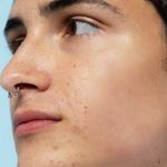 Improve skin